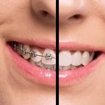 remove braces photoshop cover